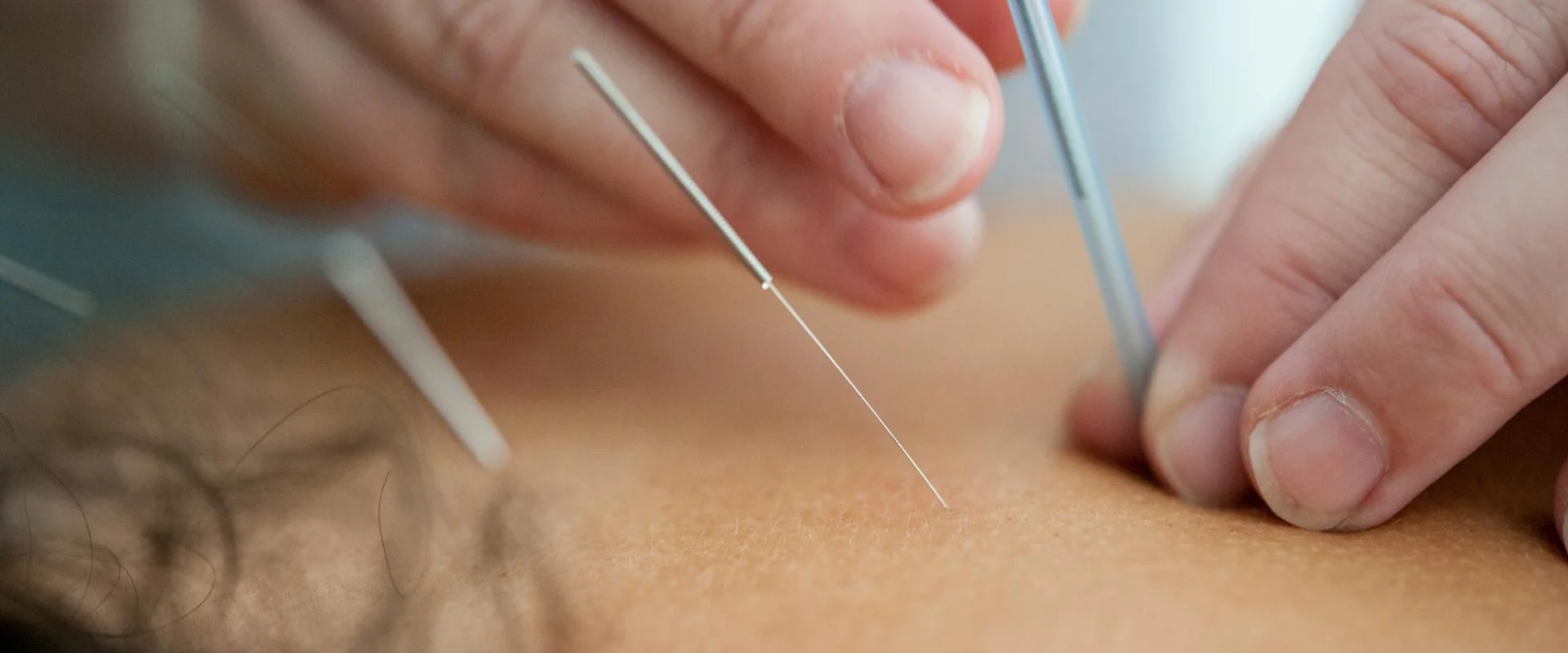 Akupunktur